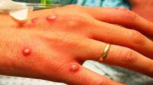 The cdc and health officials in dallas said. Monkeypox Uk Reports Two Cases Of This Rare Disease All You Need To Know
