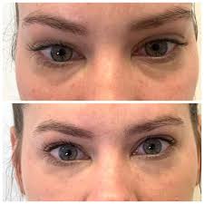 Softer tear trough fillers made of hyaluronic acid, such as restylane or juvederm ultra, can relieve the tired, hollow. Tear Trough Fillers Perth No Surgery For Beautiful Eyes