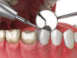 Clean teeth for braces, teenagers, plaque can be removed at home. Are Plaque Removal Tools Safe To Use At Home Dental Blog Aura Dental
