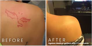This is the best laser tattoo removal option miami for sure. Laser Tattoo Removal Ageless Medical Premier Medspa Serving Weston Pembroke Pines And Davie