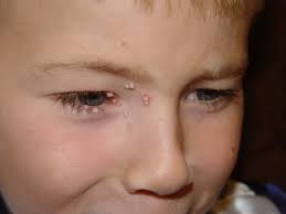 You can boil neem leaves in water and then topically apply this infused water to the affected areas on the skin. Molluscum Contagiosum Molluscipoxvirus Dermatology Advisor