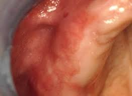 Image result for Erythroplakia roof of mouth