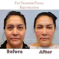 ◯Fat Grafting◯ by Dr. Richard Huynh, also known as far transfer ,is a  surgery that transfer fat taken out from abdomen to wrinkles