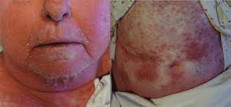 Typical Appearance Of Staphylococcal Scalded Skin Syndrome Ssss Download Scientific Diagram