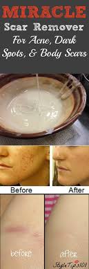 Miracle Homemade Scar Remover For Acne And Dark Spots Recipe Acne Dark Spots Skin Treatments Skin Cure