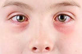 Image result for Gonococcal Conjunctivitis