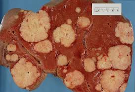 How is advanced cancer found? Pancreatic Cancer Wikiwand