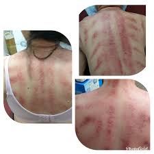 和氣堂氣穴刮痧專門店, lai chi kok, hong kong. æ­£åˆå ‚æŽ¨æ‹¿æ•´å¾©é¤¨ åˆ®ç—§åŠŸæ•ˆ Facebook