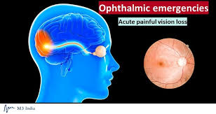Image result for Acute Vision Loss