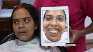 Jaw Surgery for Gummy Smile