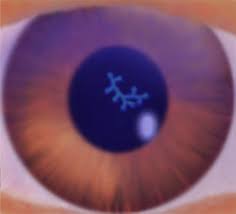 Hsv keratitis is a major cause of blindness worldwide 1. Illustration Of A Dendritic Ulcer Caused By Hsv Notes The Dendritic Download Scientific Diagram