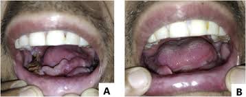 Mucormycosis is a very rare infection. Case Of Mucormycosis Of Mandible After Self Extraction Of Teeth Incidentally Detected To Have Chronic Granulomatous Disease Case Report And Literature Review Sciencedirect