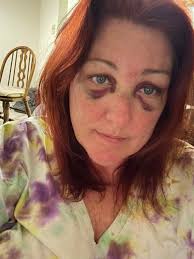 I had a seizure while driving yesterday and ran into a brick wall.