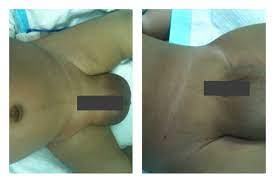 Pada bayi prematur, 73 per 1000. Angin Pasang Hernia Pada Bayi Tak Boleh Diurut Sebarangan 7 Perkara Perlu Tahu