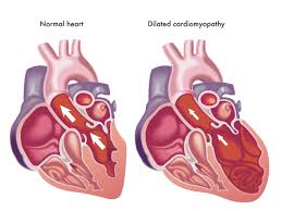 Image result for Cardiomyopathy