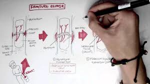 Start studying chapter 4 backbone distribution systems. Bone Fracture Types Fracture Repair And Osteomyelitis Youtube