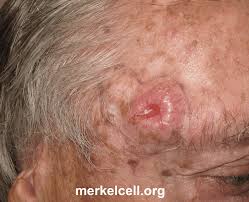 Image result for Merkel Cell Carcinoma