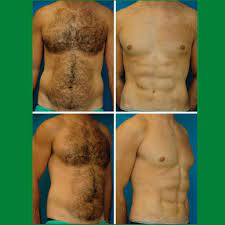 عملية السكس باك