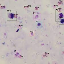 In all stages, however, the same parts of the parasite will stain the same colour you will need to refocus, using the fine adjustment, each time you move the microscope field: Pdf Image Analysis For Malaria Parasite Detection From Microscopic Images Of Thick Blood Smear
