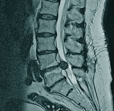 Bandscheibenvorfall l5 s1 wann operieren or treat. Ruckenschmerzen Wann Muss Operiert Werden Doctors Today