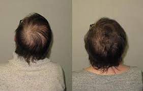 In one clinical study, this was reported in up to 5.2% of women taking the drug. Management Of Hair Loss In The Face Of Endocrine Therapy