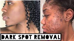The ordinary's alpha lipolic acid is my hg for hyperpigmentation. Skin How To Get Rid Of Dark Scars Hyperpigmentation Acne Scars At Home No Click Bait Youtube