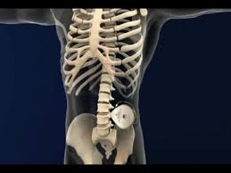 Image result for Intrathecal Pump