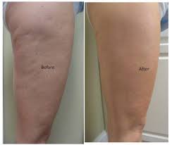 Shop our slendertone devices now online. Pin On Leg