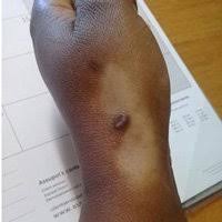 Image result for Skin Trauma