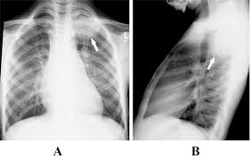 Your lungs are two spongy organs in your chest that take in oxygen when you inhale and the risk of lung cancer increases with the length of time and number of cigarettes you've smoked. Large Pulmonary Solitary Mass Caused By Mycobacterium Tuberculosis Mimicking A Malignant Tumor In A Child Sciencedirect