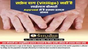Ayurvedic Treatment For Vitiligo Leucoderma By Shuddhi Issuu