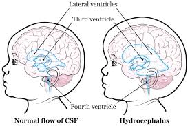 About Your Endoscopic Third Ventriculostomy Etv Surgery For Pediatric Patients Memorial Sloan Kettering Cancer Center