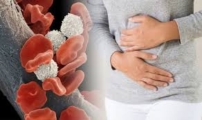 Leukemia symptoms include easily bruising or bleeding. Blood Cancer Symptoms Three Easily Missed Signs Of The Disease You Need To Know Sound Health And Lasting Wealth