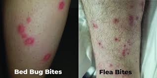 Image result for flea bites