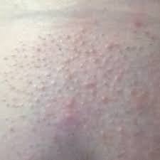 Within the context of pairs therapy/marriage counseling, sex counseling concentrates on the experience in between the individuals within the therapy workplace, your therapist is there to assist you, not be an individual! This Is On My Vagina Ever Since I Shaved It Is This Normal R They Ingrown Hairs Will They Become Ingrown Hairs How Can I Fix This Help Glow Community