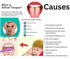 Image result for yellow tongue infection