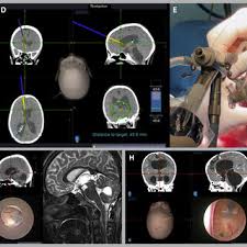 Intraventricular time navigation. Assembly description. (A) The LOTTA...