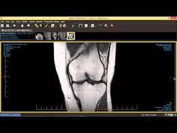how to read knee mri knee mri meniscus tear mri