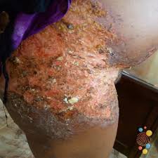 Image result for herpes zoster