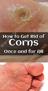 How To Get Rid Of Corns Get Rid Of Corns Corn On Toe Corn Treatment