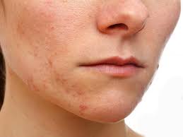 For eczema, you can visit doctor to get some prescriptions; Pin On Eczema Living