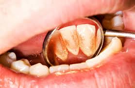 Tartre & tartre is a general practice law firm based out of rumford, maine. Apprendre A Prevenir Le Tartre Bucco Orthodontie Par Vos Orthodontistes