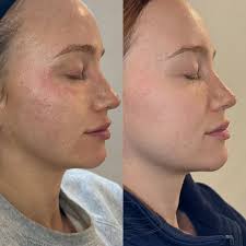ONE SESSION OF MORPHEUS8 ONLY. This treatment is PERFECT for those wanting  to improve their skin 🤗 improves texture, tightens skin, brighter  complexion! This treatment can be booked for *PROMO PRICING* through