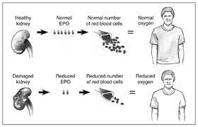 Kfwny Anemia In Chronic Kidney Disease