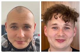 Transgender Hair Transplants