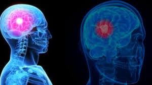 Maybe you would like to learn more about one of these? 8 Gejala Sepele Ini Menandakan Kamu Terserang Tumor Otak Serambi Indonesia