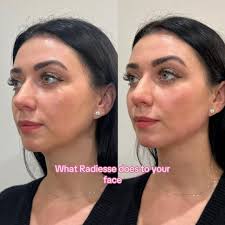 Hyperdilute Radiesse