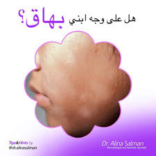 النخالة البيضاء هذه البقع البيضاء ليست Dr Alina Salman Facebook