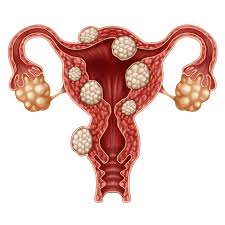 For uterine polyps, your doctor might. Is It An Ovarian Cyst Or A Fibroid Cherokee Women S Health