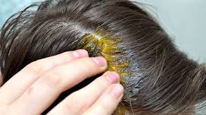 Sac Beyazlamasina Bitkisel Cozum Sogan Suyu Kuru Hair Remedies For Growth Thick Hair Remedies Onion For Hair